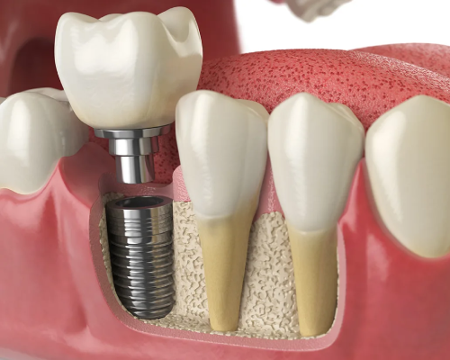 Dental Implants